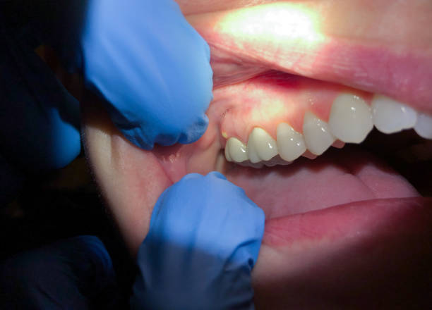 Best Emergency Root Canal Treatment in Woodridge, IL