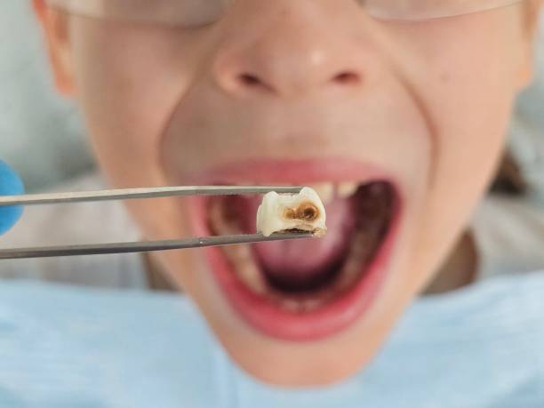Best Broken or Cracked Tooth Emergency Dentist in Woodridge, IL