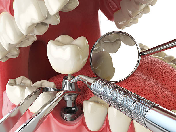 Best Emergency Dentist for Knocked-Out Tooth in Woodridge, IL